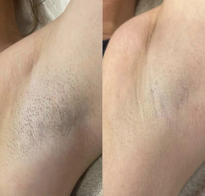Appareil d'Épilation à Lumière Pulsée – Épilation Permanente à Domicile